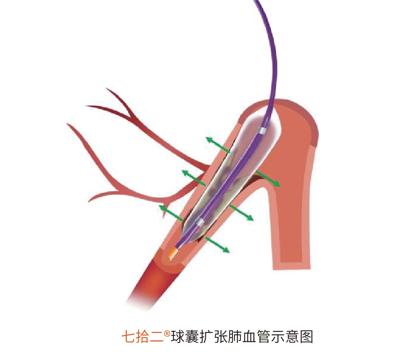 七拾二?Sev-changes 肺動(dòng)脈球囊擴(kuò)張導(dǎo)管(圖2)